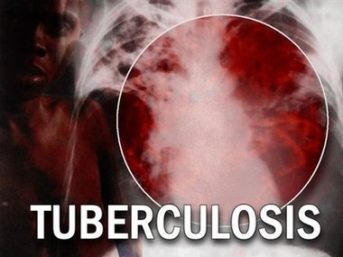 Penyakit Tbc Menular Tidak